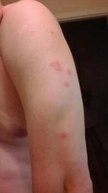 red rash on back of arm