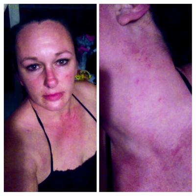 red lacy vein rash on check and face