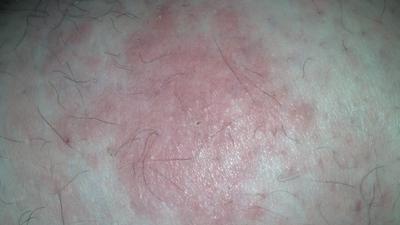 reoccurring itch rash on leg in the same spot
