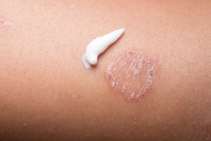 ringworm fungal skin rash on arm requiring a ringworm treatment