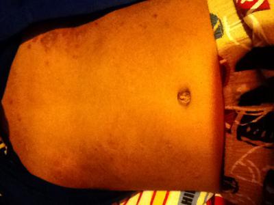 Scabby skin rash problem on chest.