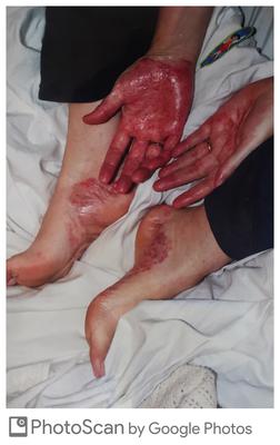 Palmoplantar-pustular Psoriasis severe foot and hand skin rash