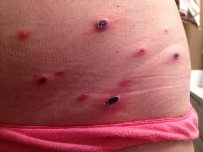 Red marks on the abdomen caused by a rare autoimmune disorder brought on by stress.