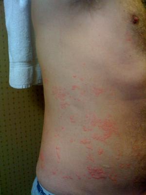 skin rash on side of body