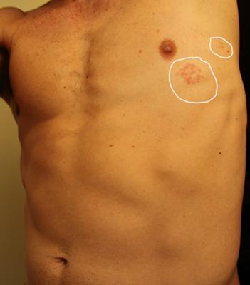 Skin Rash on Chest with Fever