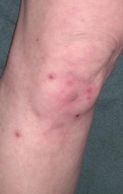 Skin Rash on Legs and Knees 