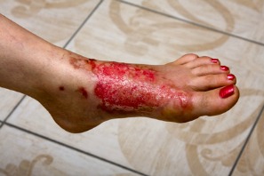 bad skin burn on foot