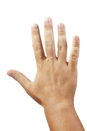skin warts on fingers and hand caused by the wart virus