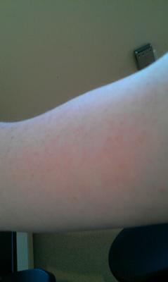 Picture of the red dots skin rash on my arm.