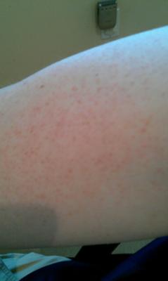 Rash on my arm consisting of small red dots that are not itchy.