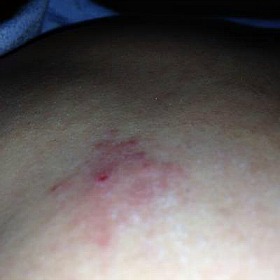 small itchy rash on back