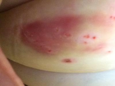 Sores on bottom of stomach