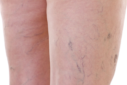 spider veins on legs