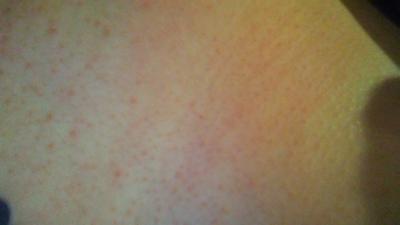 Skin rash on the side of stomach.