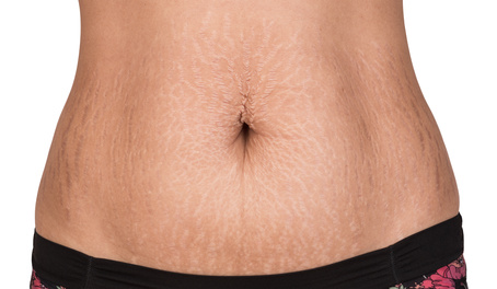 stretch marks on the stomach of a woman