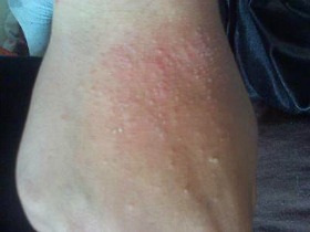 summer rash on hands and elbows