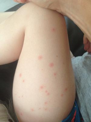 itchy red spots on thigh