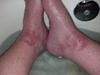 Red skin rash on both ankles