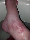 Blistering red skin rash on left ankle