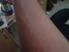 swollen sweat rash on arm
