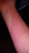 Burning bright red skin rash on arm.