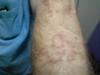 circular skin rash on arm is not ringworm
