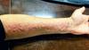 Dermatographism skin writing disease on forearm possibly linked to heartburn, allergies, and fatigue.