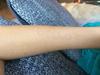 Dermatographism skin problem on arm with no raised skin welts only redness.