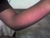 Inflammations in skin on arm done with fingernails
