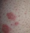 Red blotchy rash on skin.