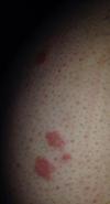 Red blotchy itchy rash on skin.