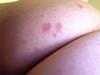 Red blotchy spreading rash on skin.
