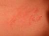 close up of skin rash on stomach