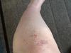 Intense itchy skin rash on leg.