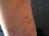 Intense itchy skin rash on arm.