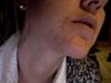 Lamictal Rash on Face
