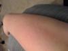 Little white bumps rash on arm