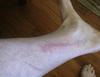 mystery rash on leg and ankle skin area