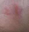 raised pink or red groin rash with no itch but a slight sting