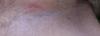 pink stinging rash in groin area