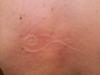 Raised skin welt on the back in the form of a distinct pattern.