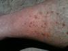 Rash on Shins and Calves