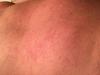 Red scratch like dotted skin rash on back.