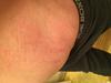 Close up view of red scratch like rash on torso.