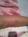 Reddish bubbly non-itchy rash on leg.