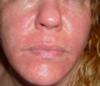Reoccurring Itchy Red Skin Rash on Face