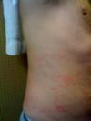 skin rash on side of body