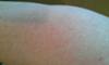 Small Red Dots Rash on Arm