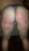 Rash on buttocks and legs possibly caused by streptozyme or strep.