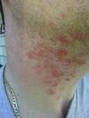 Unknown non itchy skin rash on neck